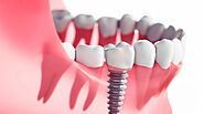 Can Dental Implants Really Be Done in a Day?