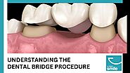 Understanding the Dental Bridge Procedure
