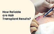 How Reliable are Hair Transplant Results?