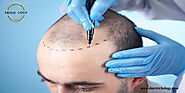 Hair Transplant For Curly and Wavy Hair