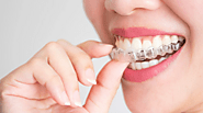 Invisalign vs. Traditional Braces: Making the Right Choice