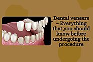 Dental veneers – Everything that you should know before undergoing the procedure
