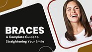 Braces: A Complete Guide to Straightening Your Smile