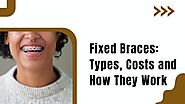 Fixed Braces: Types, Costs and How They Work