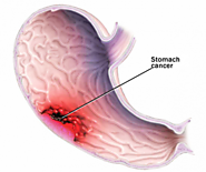 Stomach Cancer - Gastric Cancer