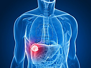 Liver Cancer - A Fatal Disease