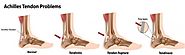 Common Disorders of the Achilles Tendinitis and Daily Exercises