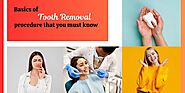 Basics of tooth removal procedure that you must know