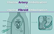 Your Guide to Uterine Artery Embolization