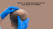 What a hair transplant is and how it works?