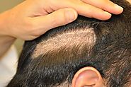 Biofibre Hair Implant Procedure - Rejuvenate Hair Clinics