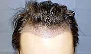 Benefits of Follicular Unit Extraction- Rejuvenate Hair Clinics