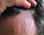 Common Scalp Problems That Might Lead to Hair Loss