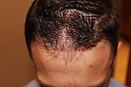 Unshaven FUE (UFUE) Restoration Procedure - Rejuvenate Hair Clinics