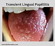 Transient Lingual Papillitis: Symptoms, Causes, Treatment