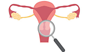 Intramural Leiomyoma of the Uterus: Symptoms, Causes, and Treatment Options