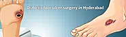 Diabetic Foot Ulcer Surgery Cost in Hyderabad - My Health Hospitals