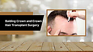 Balding Crown and Crown Hair Transplant Surgery