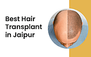 What Do Hair Transplant Packages Include?