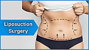 Liposuction Surgery Cost & Expert Cosmetic Treatments