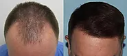 The Meaning of KSL Hair Transplant: What You Need To Know - Hairhealthtips.com