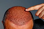 The Timeline of DHI Hair Transplant: A Full Guide - Hairhealthtips.com