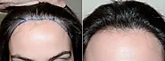 The Healing Process After DHI Hair Transplant: A Full Guide - Hairhealthtips.com