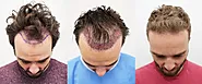 Does FUE Hair After Transplant Look Natural: A Full Guide - Hairhealthtips.com