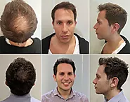 Bosley Hair Transplants: Are the Results Truly Permanent? - Hairhealthtips.com
