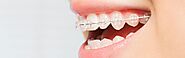 Quick Smile Braces | Quick Way to Straighten Teeth