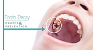 Website at https://www.sw19confidental.co.uk/causes-of-tooth-decay-and-how-to-get-rid-of-them/