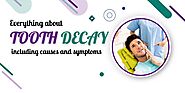 Everything about tooth decay including causes and symptoms 