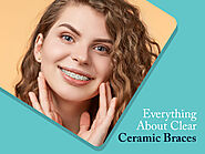 Everything to Know About Clear Ceramic Braces