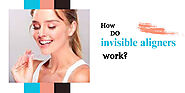 How do invisalign invisible aligners work?