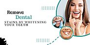 Remove Dental Stains by Whitening Your Teeth