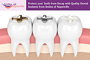 Protect your Teeth from Decay with Quality Dental Sealants from Smiles of Naperville