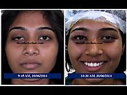 Eyelid Surgery, Ptosis Surgery in Mumbai - Dr. Debraj Shome Blog