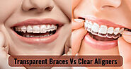 Ceramic Braces vs Clear Aligners: Which Will Suit You Better?