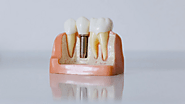 Understanding the Dental Implant Process — A Comprehensive Guide