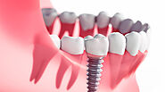 When Are Dental Implants Necessary?