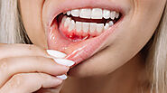 5 Signs You May Have Gum Disease