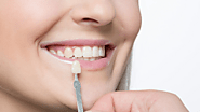 Things to Know Before Getting Porcelain Dental Veneers