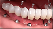 Dental implants Summerlin