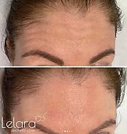 Highly Specialized Botox Services in Dubai