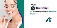 What is Invisalign: A Discreet Alternative to Traditional Braces