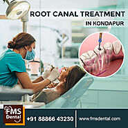 Best Clinic for Root Canal Treatment in Kondapur