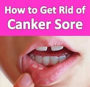 How to Get Rid of Canker Sores Fast | Virtual Clinic