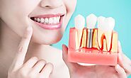 Securing Your Smile: Exploring Dental Implants in Denton