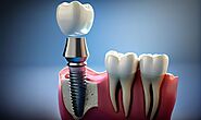 Permanent Smiles: A Deep Dive into Dental Implants Denton