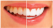 Teeth Whitening 4 You - How to Whiten Your Teeth Easily, Naturally & Forever!